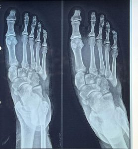 🦴 Lisfranc Injury (Midfoot Fracture) Treatment in Ahmedabad, Rajkot & Surat