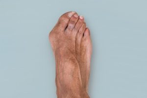 Best Foot & Ankle Specialist in Ahmedabad – Dr Ankit Kamothi