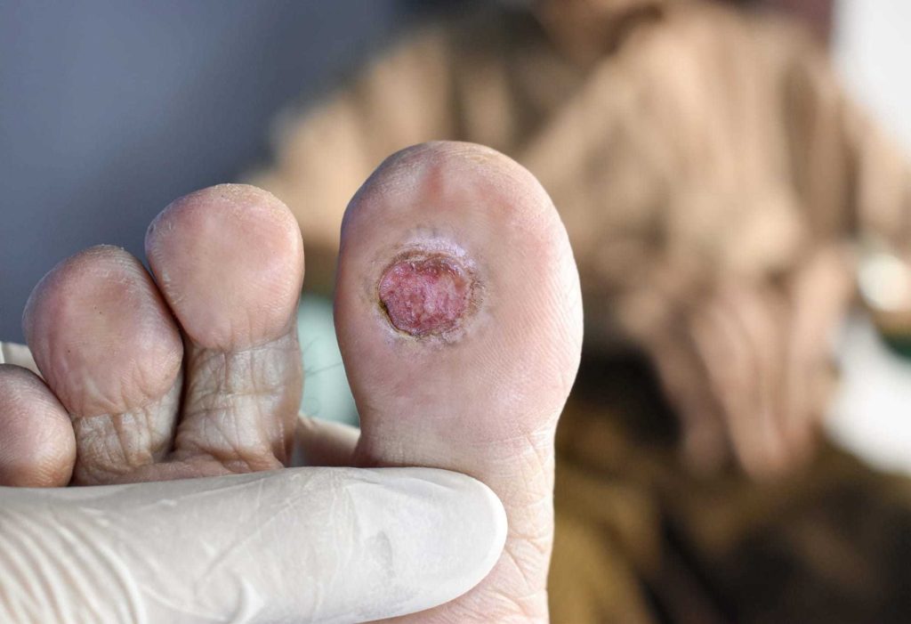 diabetic foot ulcer treatment in Gujarat
